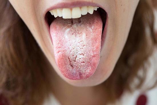 برفک دهان چیست؟ علائم و راه های درمان آن را بشناسید