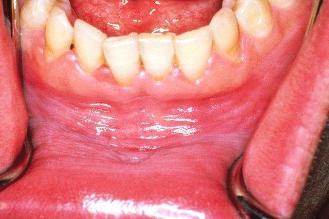 تولید چسب مخاطی کورکومین برای درمان ضایعات زخمی لیکن پلان دهانی