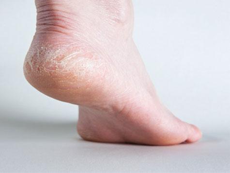 چرا کف پا خشک می شود؟
