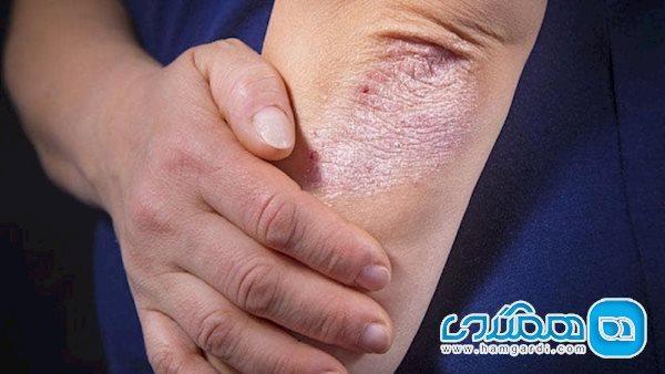 اگزما، بیماری پوستی در روزهای کرونایی
