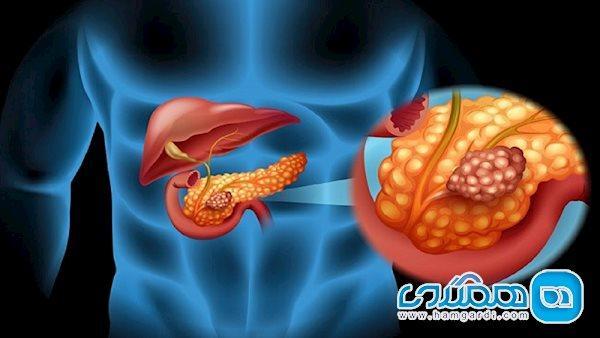 بیماری کشنده ای که به سرطان خاموش معروف است بیماری کشنده ای که به سرطان خاموش معروف است