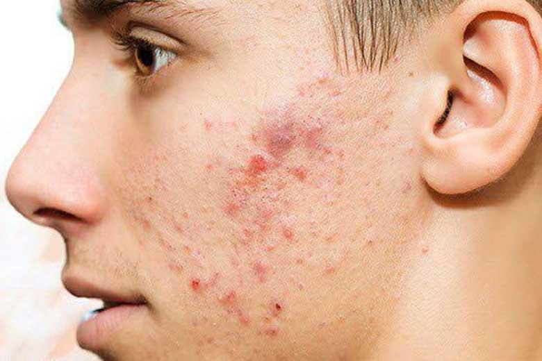 علت جوش زدن پوست صورت چیست؟ علت جوش زدن پوست صورت چیست؟