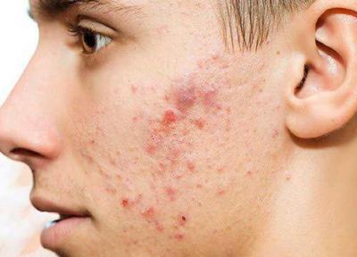 علت جوش زدن پوست صورت چیست؟