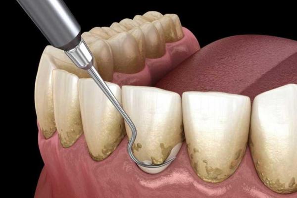 چرا جرمگیری دندان ها مفید است؟