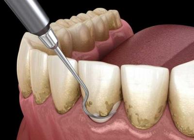 چرا جرمگیری دندان ها مفید است؟