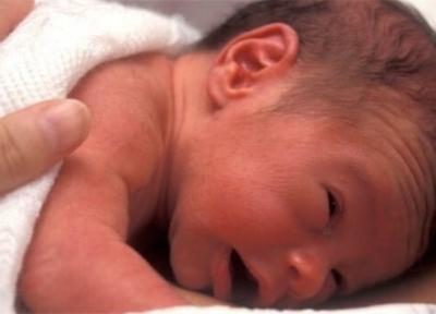 عارضه گلوکوم در کمین نوزادانی که تحت جراحی آب مروارید قرار می گیرند