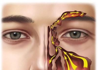 رنگ مخاط بینی و شرایط سلامت شما