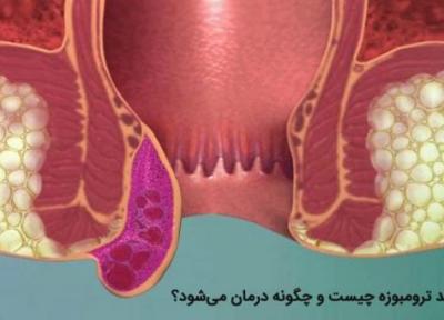 هموروئید ترومبوزه چیست؟