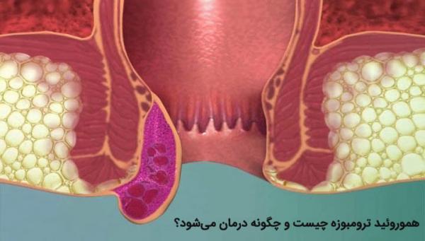 هموروئید ترومبوزه چیست؟