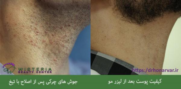 مزایا و فواید لیزر موهای زائد نسبت به سایر روش ها مزایا و فواید لیزر موهای زائد نسبت به سایر روش ها