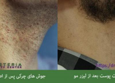 مزایا و فواید لیزر موهای زائد نسبت به سایر روش ها