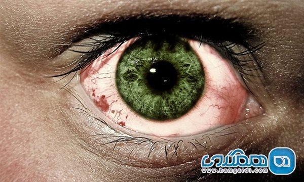 از دست دادن کوتاه مدت دید یا نابینایی موقتی از دست دادن کوتاه مدت دید یا نابینایی موقتی