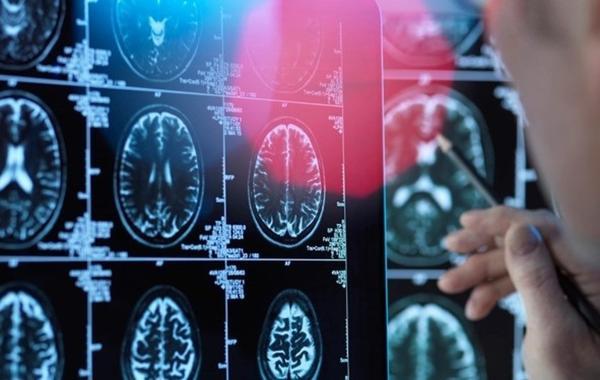 کشف راه چاره تشخیص آلزایمر تا 3 سال زودتر
